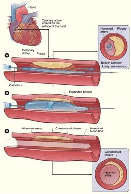 angiogram price in heart center|Coronary Angioplasty .